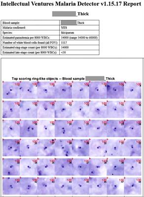 Evaluation of an automated microscope using machine learning for the detection of malaria in travelers returned to the UK